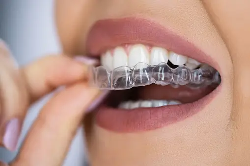 dental braces and orthodontics