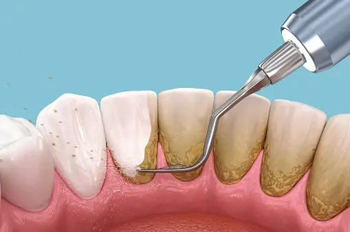 Scaling and root planing - hygienic services