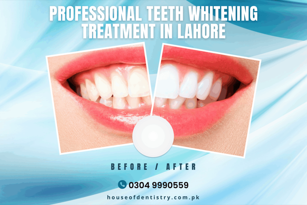 Teeth Whitening