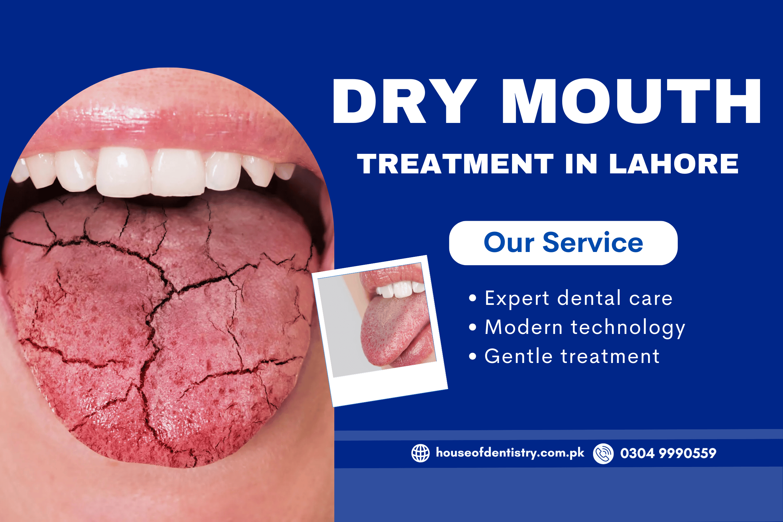 Dry Mouth